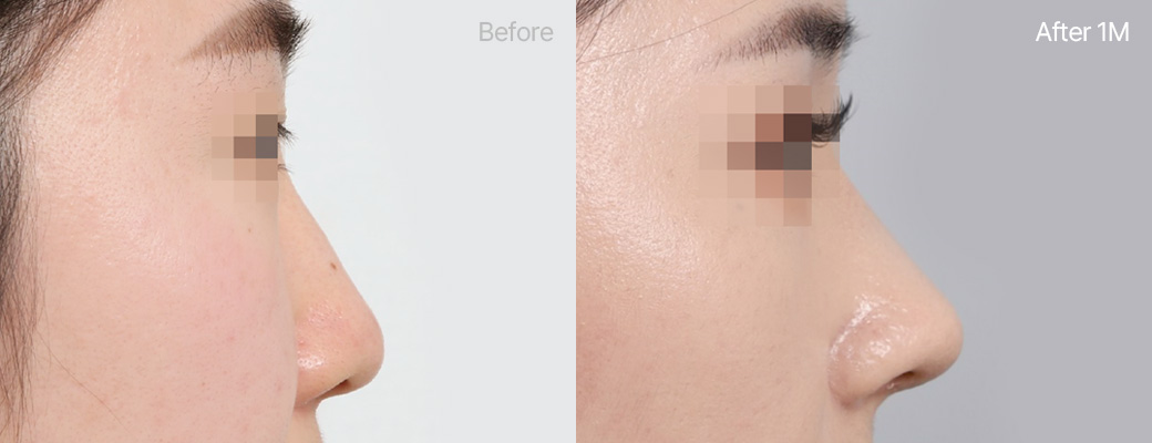 기본코성형 자가늑연골 전후사진