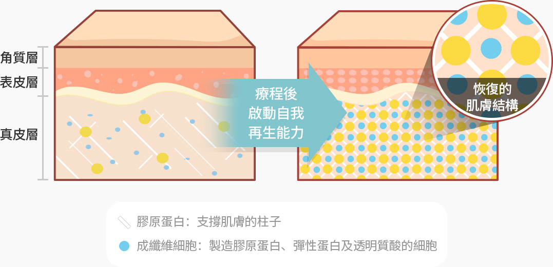 리쥬란 패키지 시술 후 자가 재생능력 활성화 복원된 피부구조