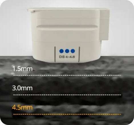 울쎄라 실시간 영상으로 보이는 초음파 리프팅